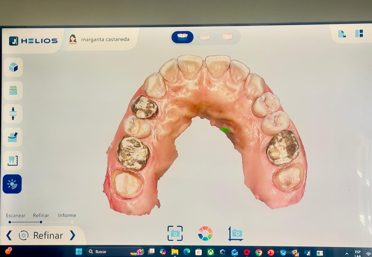 Modelo 3D del escaneo dental digital mostrado en pantalla al paciente
